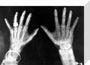 X-rays of the hands of King George and Queen Mary, 1896. stretched canvas small none Art Print - Science Museum Shop