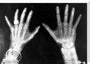 X-rays of the hands of King George and Queen Mary, 1896. stretched canvas large none Art Print - Science Museum Shop